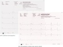Electrocardiografo marca Mindray Modelo BENEHEART R12